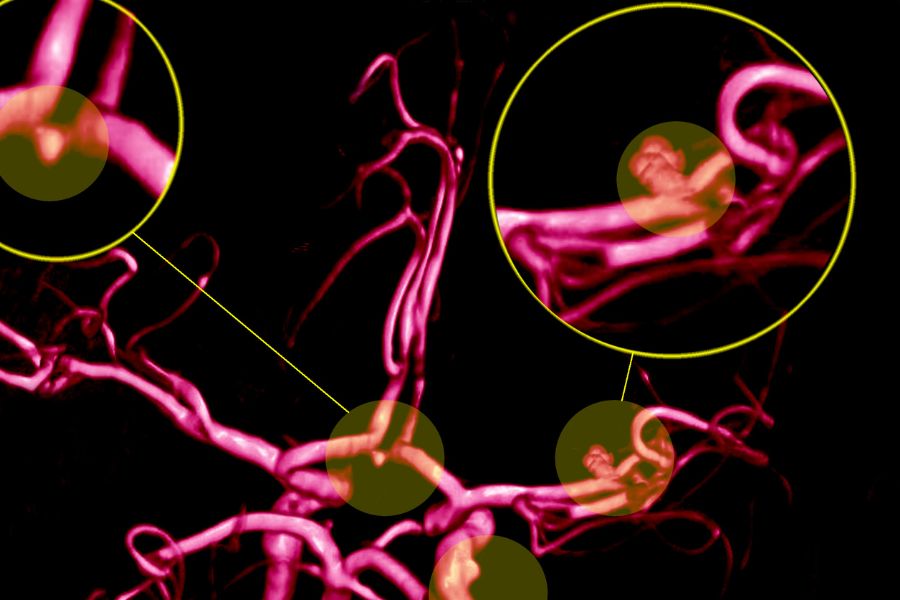 Conheça os sintomas de Aneurisma Cerebral
